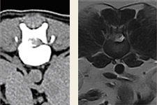 椎間板ヘルニアの1例（左：CT／右：MRI）